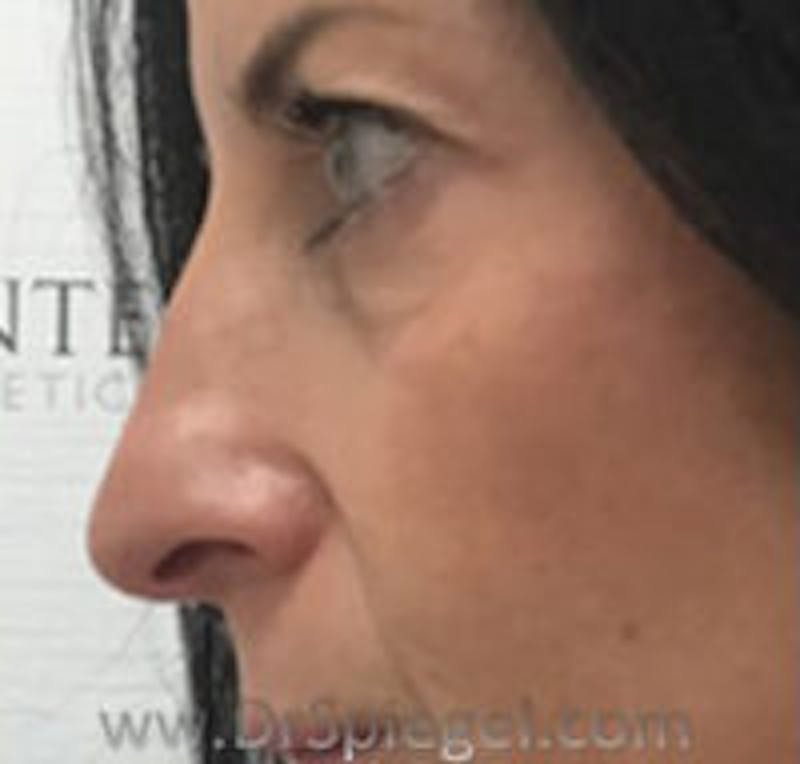 Non-Surgical Rhinoplasty / Nose Filler Before & After Gallery - Patient 157140981 - Image 3