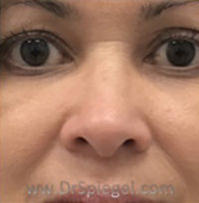 Non-Surgical Rhinoplasty / Nose Filler Before & After Gallery - Patient 157140983 - Image 1