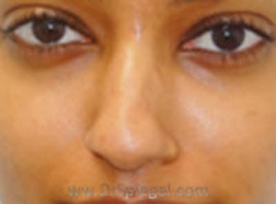 Non-Surgical Rhinoplasty / Nose Filler Before & After Gallery - Patient 157140984 - Image 1