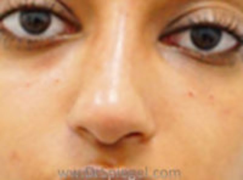 Non-Surgical Rhinoplasty / Nose Filler Before & After Gallery - Patient 157140984 - Image 2