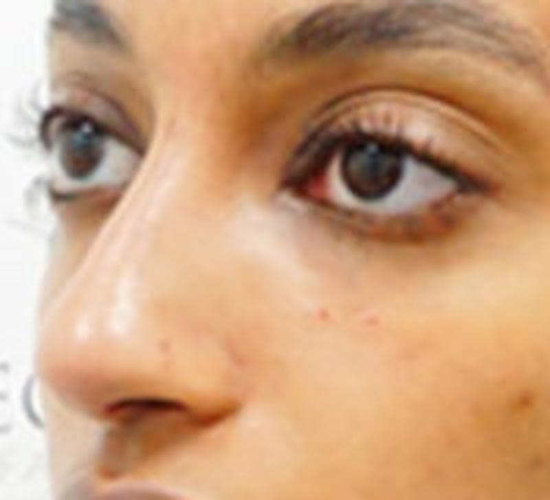 Non-Surgical Rhinoplasty / Nose Filler Before & After Gallery - Patient 157140984 - Image 4