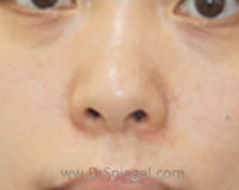 Non-Surgical Rhinoplasty / Nose Filler Before & After Gallery - Patient 157140985 - Image 1