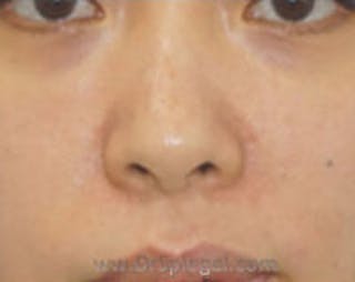 Non-Surgical Rhinoplasty / Nose Filler Before & After Gallery - Patient 157140985 - Image 2