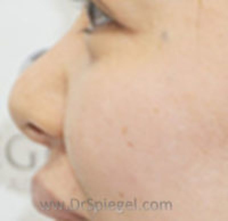Non-Surgical Rhinoplasty / Nose Filler Before & After Gallery - Patient 157140985 - Image 3