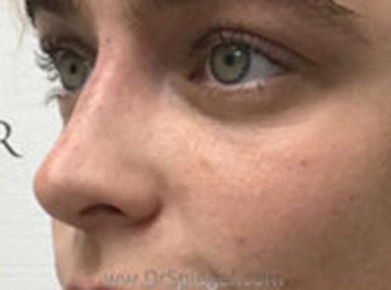 Non-Surgical Rhinoplasty / Nose Filler Before & After Gallery - Patient 157140987 - Image 2