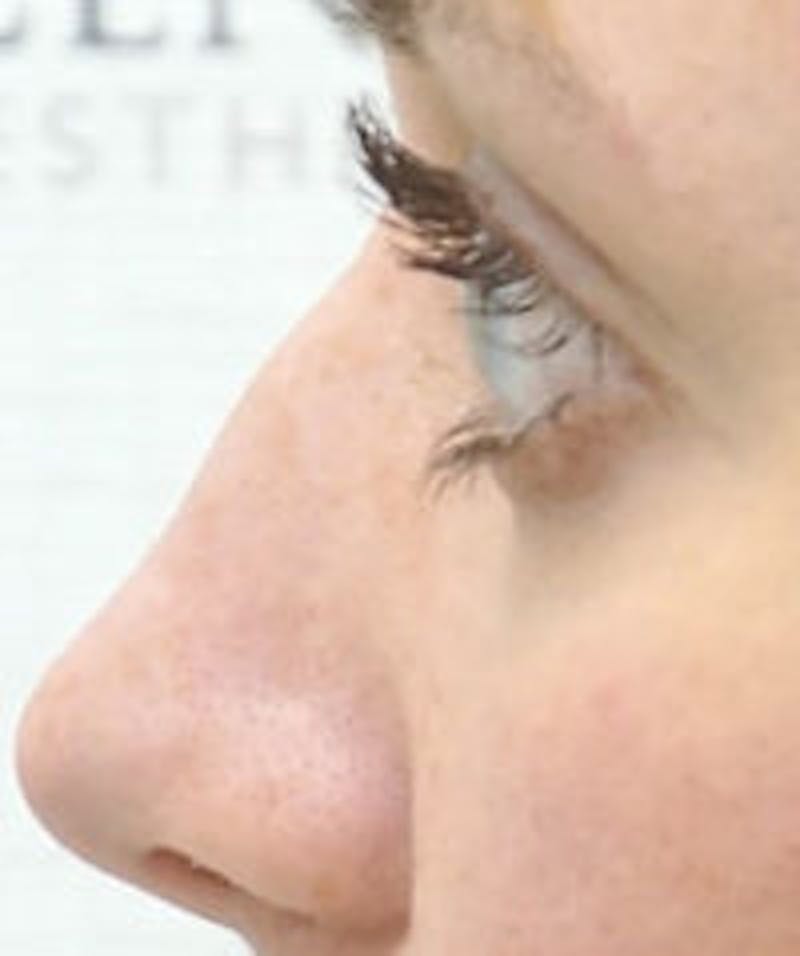 Non-Surgical Rhinoplasty / Nose Filler Before & After Gallery - Patient 157140988 - Image 1