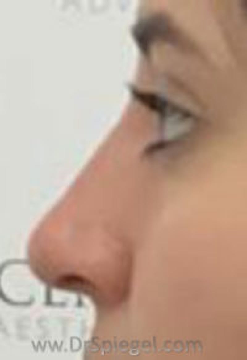 Non-Surgical Rhinoplasty / Nose Filler Before & After Gallery - Patient 157140989 - Image 2