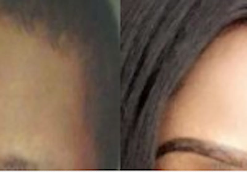 Thumbnail for Forehead Contouring: Myths & Facts