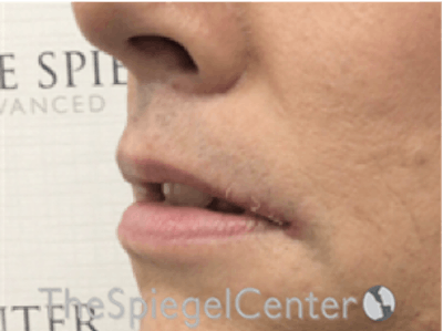 Lip Lift Before & After Gallery - Patient 162620111 - Image 4