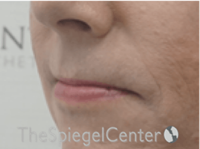 Lip Lift Before & After Gallery - Patient 162620111 - Image 3
