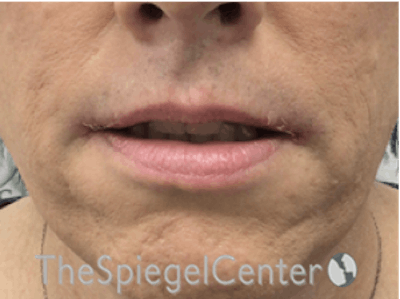 Lip Lift Before & After Gallery - Patient 162620111 - Image 2