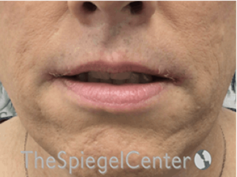 Lip Lift Before & After Gallery - Patient 162620111 - Image 2