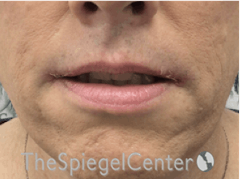 Lip Augmentation / Lip Implant / Lip Lift Before & After Gallery - Patient 162620111 - Image 2