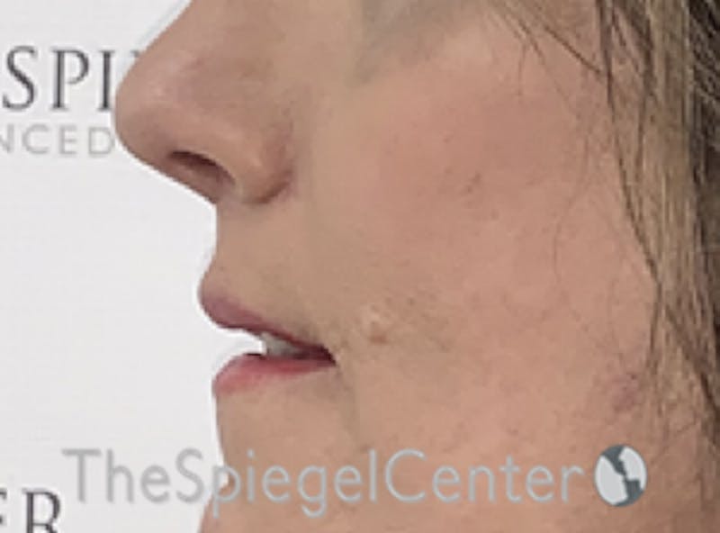 Lip Augmentation / Lip Implant / Lip Lift Before & After Gallery - Patient 162620088 - Image 4