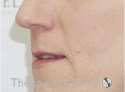 Lip Lift Before & After Gallery - Patient 162620088 - Image 3