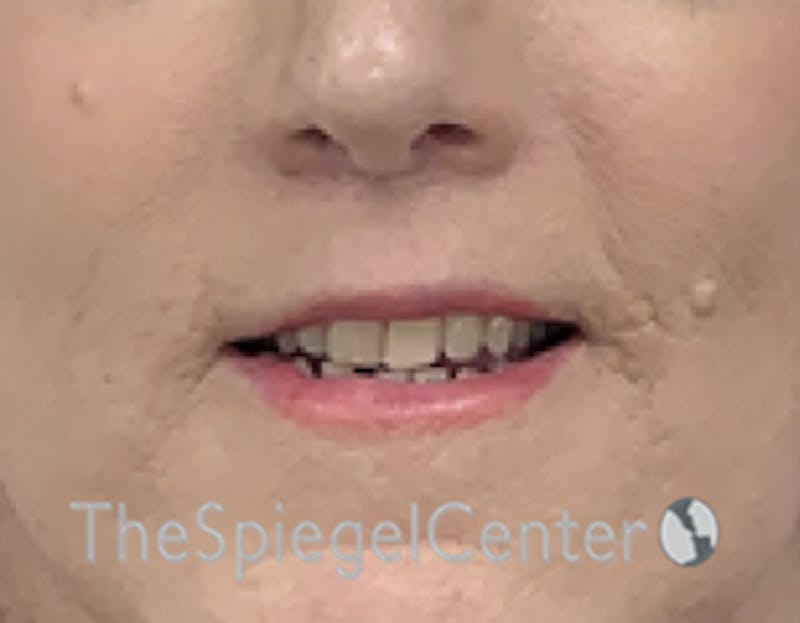 Lip Lift Before & After Gallery - Patient 162620088 - Image 2