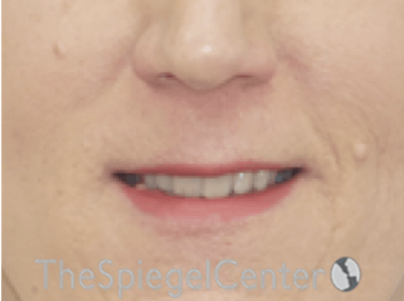 Lip Lift Before & After Gallery - Patient 162620088 - Image 1