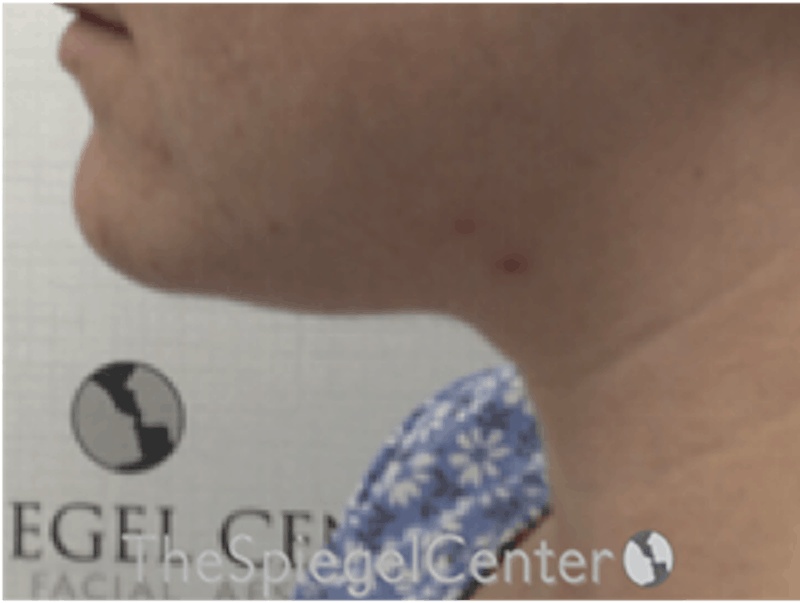 Facetite / Necktite / Embrace / Accutite Before & After Gallery - Patient 162620085 - Image 3