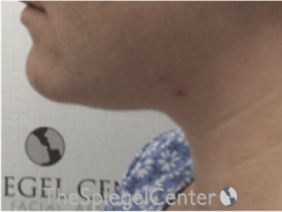 Facetite / Necktite / Embrace / Accutite Before & After Gallery - Patient 162620085 - Image 3