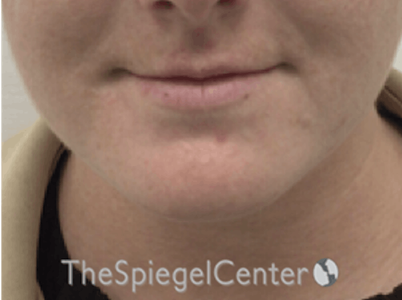 Facetite / Necktite / Embrace / Accutite Before & After Gallery - Patient 162620085 - Image 2