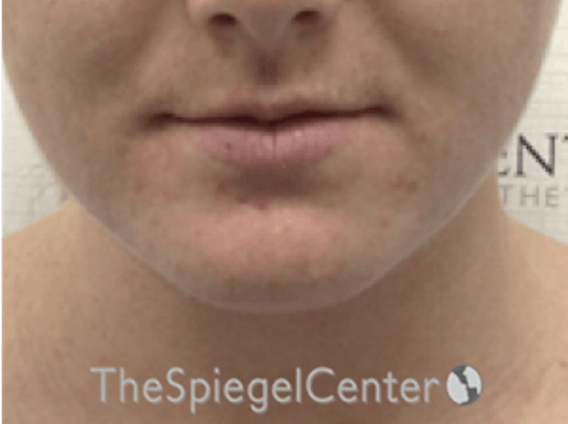 Facetite / Necktite / Embrace / Accutite Before & After Gallery - Patient 162620085 - Image 1