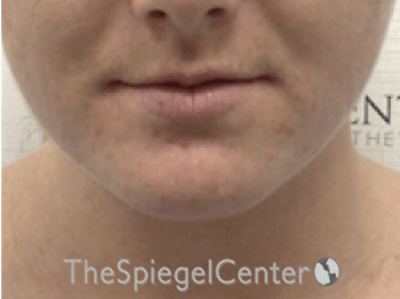 Facetite / Necktite / Embrace / Accutite Before & After Gallery - Patient 162620085 - Image 1