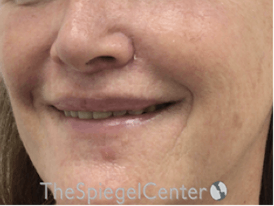 Lip Lift Before & After Gallery - Patient 162629889 - Image 4