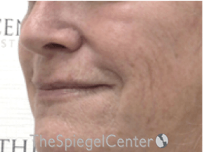 Lip Lift Before & After Gallery - Patient 162629889 - Image 3