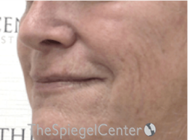 Lip Augmentation / Lip Implant / Lip Lift Before & After Gallery - Patient 162629889 - Image 3