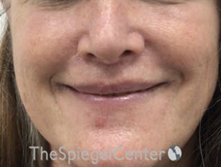 Lip Lift Before & After Gallery - Patient 162629889 - Image 2