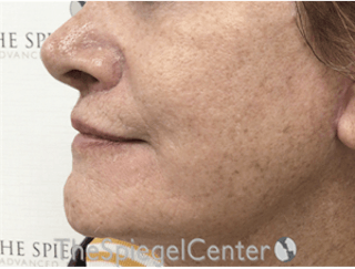 Lip Lift Before & After Gallery - Patient 162629884 - Image 4