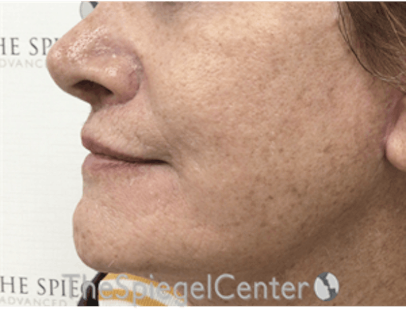 Lip Augmentation / Lip Implant / Lip Lift Before & After Gallery - Patient 162629884 - Image 4
