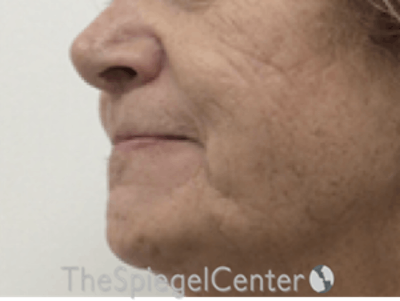 Lip Lift Before & After Gallery - Patient 162629884 - Image 3