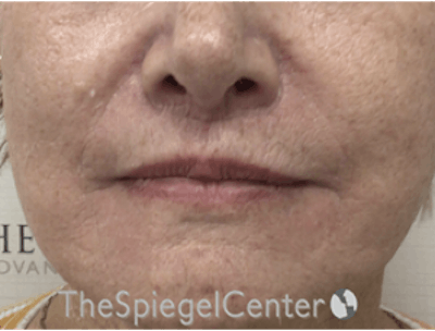 Lip Lift Before & After Gallery - Patient 162629884 - Image 2