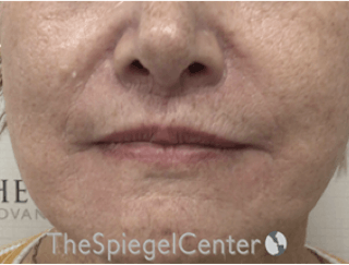 Lip Lift Before & After Gallery - Patient 162629884 - Image 2