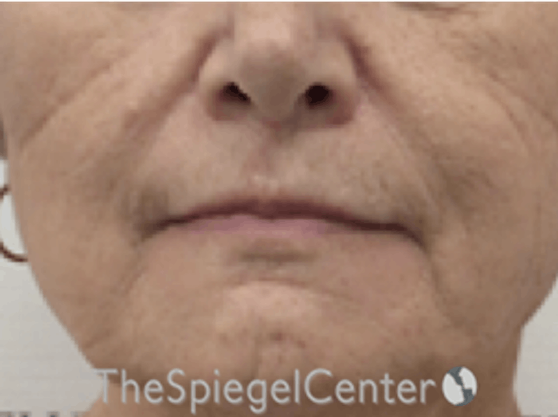 Lip Lift Before & After Gallery - Patient 162629884 - Image 1