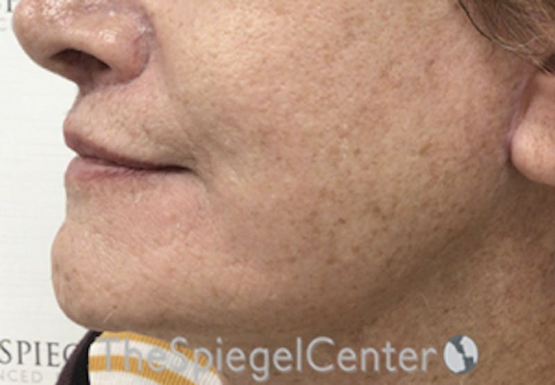 Mandible Contouring Before & After Gallery - Patient 162629875 - Image 4