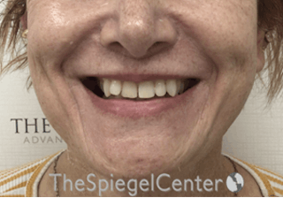 Mandible Contouring Before & After Gallery - Patient 162629875 - Image 2