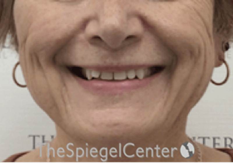 Mandible Contouring Before & After Gallery - Patient 162629875 - Image 1