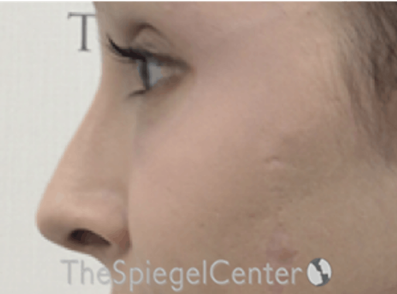 Rhinoplasty Before & After Gallery - Patient 797207 - Image 1