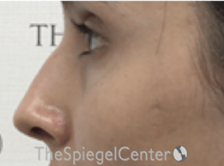 Rhinoplasty Before & After Gallery - Patient 797207 - Image 2