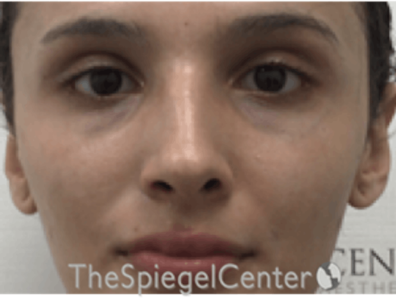 Rhinoplasty Before & After Gallery - Patient 162629951 - Image 4