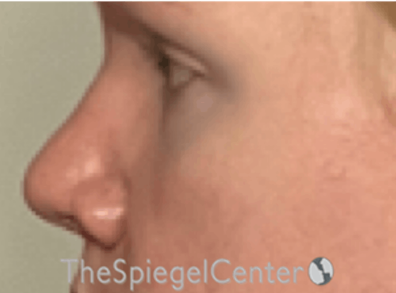 Rhinoplasty Before & After Gallery - Patient 162629927 - Image 1