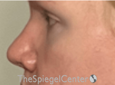 Rhinoplasty Before & After Gallery - Patient 162629927 - Image 1