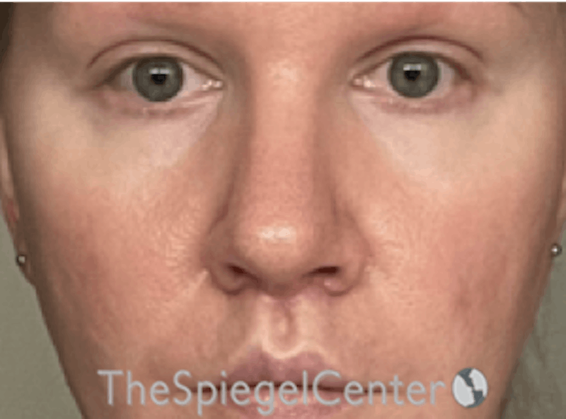 Rhinoplasty Before & After Gallery - Patient 162629927 - Image 3