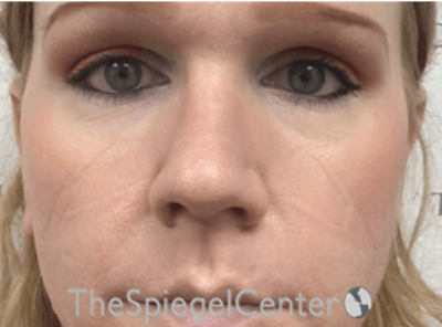 Rhinoplasty Before & After Gallery - Patient 162629927 - Image 4
