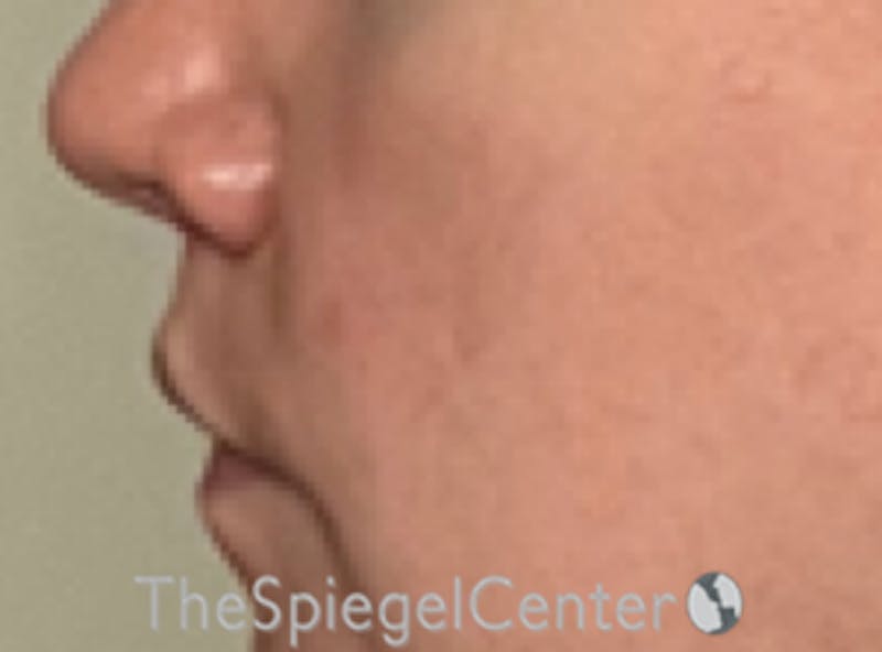 Lip Lift Before & After Gallery - Patient 162629911 - Image 4