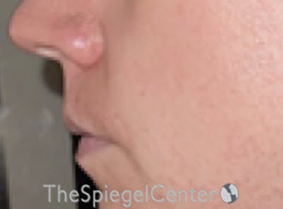 Lip Lift Before & After Gallery - Patient 162629911 - Image 3