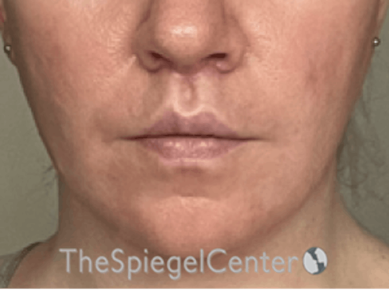 Lip Lift Before & After Gallery - Patient 162629911 - Image 2
