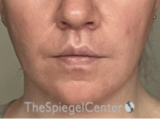Lip Lift Before & After Gallery - Patient 162629911 - Image 2